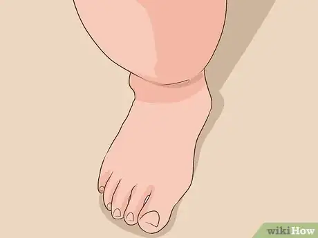 Imagen titulada Diagnose Lipedema Step 5
