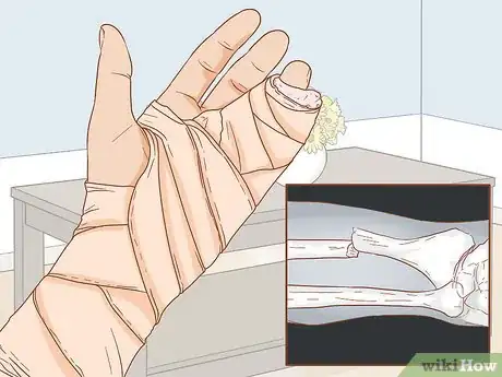 Imagen titulada Apply Different Types of Bandages Step 14