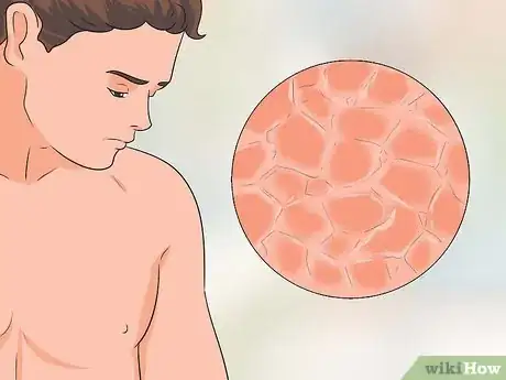 Imagen titulada Treat Itchy Breasts Step 1