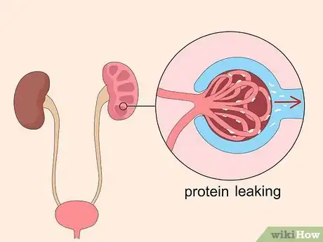 Imagen titulada Reduce Foamy Urine Step 5