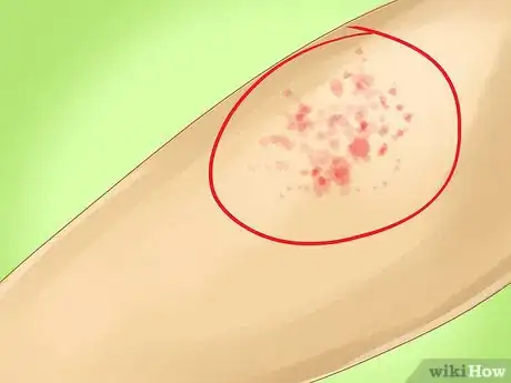 Imagen titulada Identify Measles Step 3