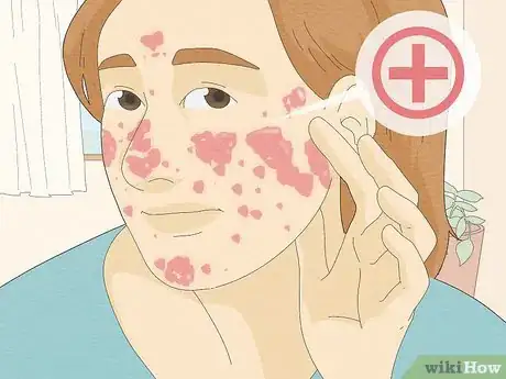 Imagen titulada Tell Eczema from Butterfly Rash Step 4