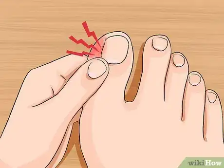 Imagen titulada Relieve Ingrown Toe Nail Pain Step 2