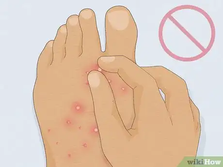Imagen titulada Treat a Fire Ant Sting Step 7