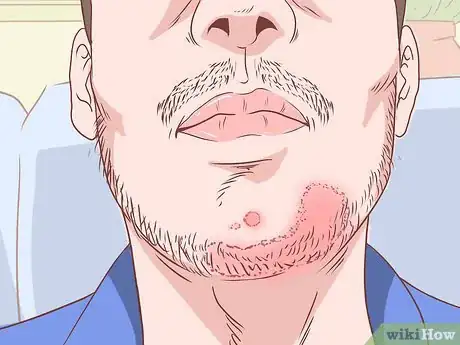 Imagen titulada Prevent Skin Fungus Step 11