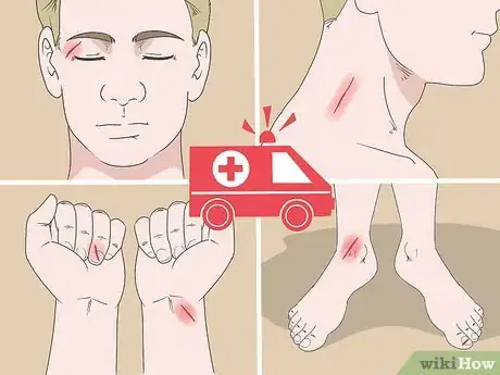 Imagen titulada Remove Glass from a Wound Step 11