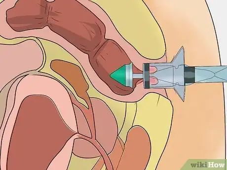 Imagen titulada Stop Bleeding Hemorrhoids Step 12