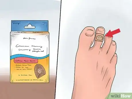 Imagen titulada Treat a Corn or Callus Step 3