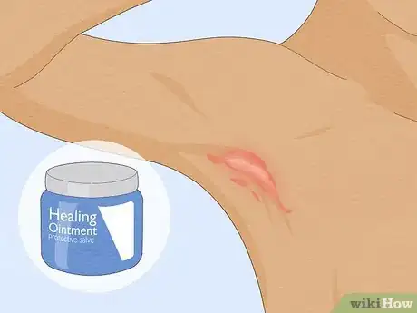 Imagen titulada Heal Raw Skin Step 12