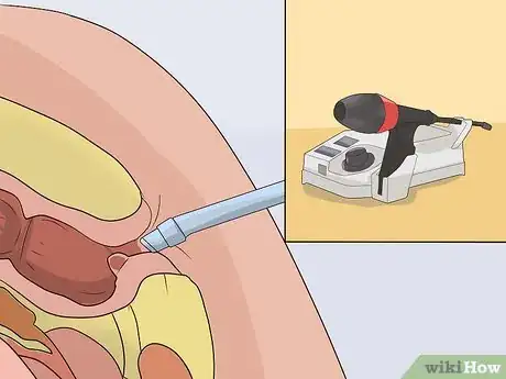 Imagen titulada Stop Bleeding Hemorrhoids Step 10
