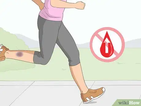 Imagen titulada Make a Bruise Go Away Faster Step 4