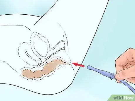 Imagen titulada Administer an Enema Step 5