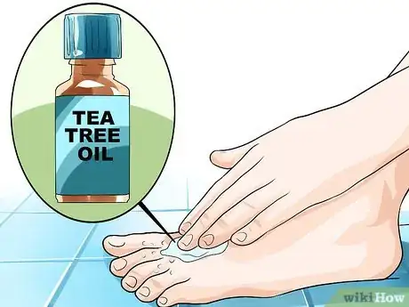 Imagen titulada Get Rid of Foot Fungus Step 3