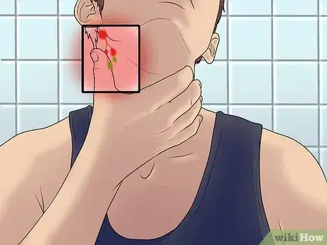 Imagen titulada Recognize Epstein Barr Symptoms Step 4