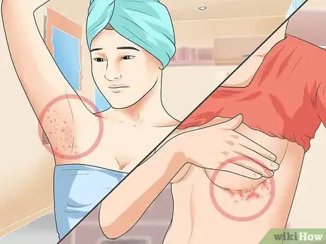 Imagen titulada Diagnose Psoriasis Step 3
