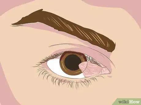 Imagen titulada Treat Surfer's Eye Step 11