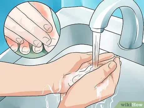 Imagen titulada Get Rid of Foot Fungus Step 4