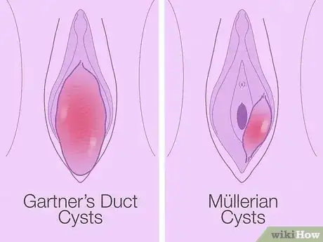 Imagen titulada Treat Vaginal Cysts Step 1
