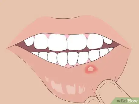 Imagen titulada Get Rid of Mouth Blisters Step 7