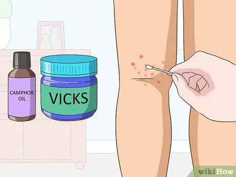 Imagen titulada Treat Chigger Bites Step 5