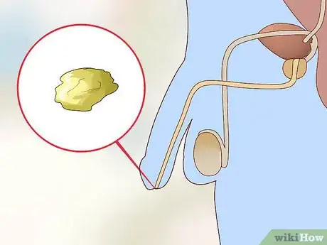 Imagen titulada Tell Signs of Sexual Infection from Penis Step 2