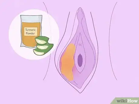Imagen titulada Treat Vaginal Cysts Step 9