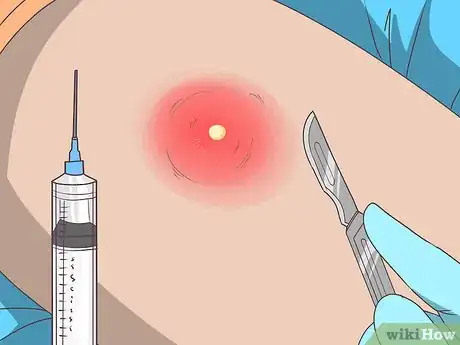 Imagen titulada Remove Pus from a Wound Step 6