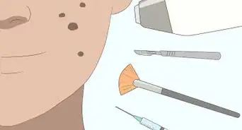 eliminar las manchas oscuras del acné