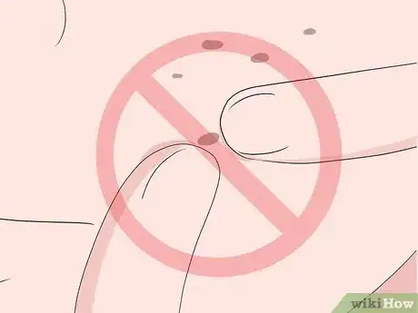 Imagen titulada Get Rid of Acne Scars Fast Step 21