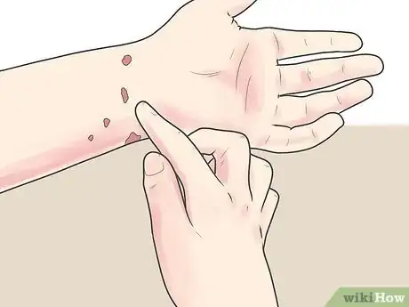 Imagen titulada Kill Scabies At Home Step 17