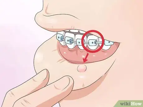 Imagen titulada Make Your Braces Hurt Less Step 8
