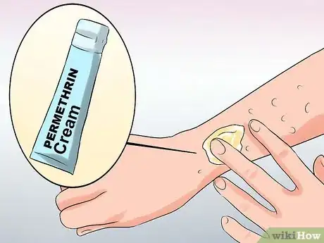 Imagen titulada Diagnose Scabies Step 10