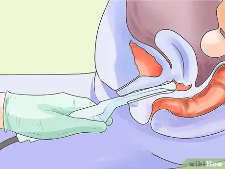 Imagen titulada Prepare for an Intravaginal Ultrasound Step 10