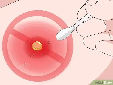 Imagen titulada Remove Pus from a Wound Step 9