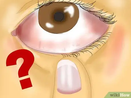 Imagen titulada Get Dirt Out of Your Eye Step 7