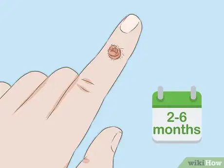 Imagen titulada Identify Warts Step 4