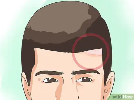 Imagen titulada Diagnose Psoriasis Step 1