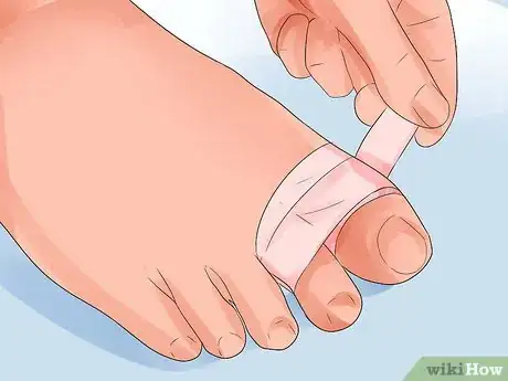 Imagen titulada Heal a Broken Toe Step 6