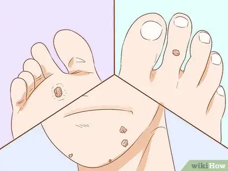 Imagen titulada Identify Warts Step 2