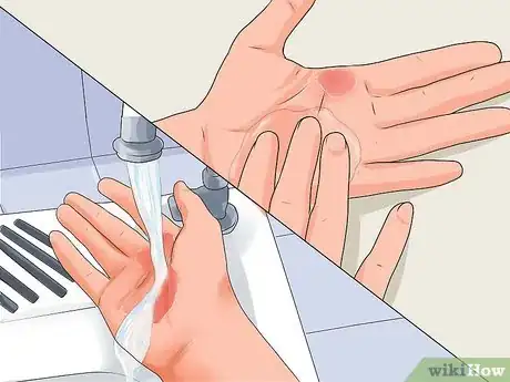 Imagen titulada Treat a Hand Burn Step 14
