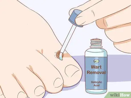 Imagen titulada Identify Warts Step 8