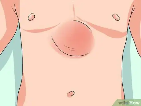 Imagen titulada Push a Hernia Back in Step 12