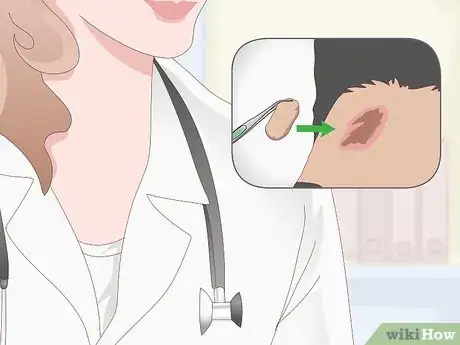 Imagen titulada Get Rid of Scars Step 11