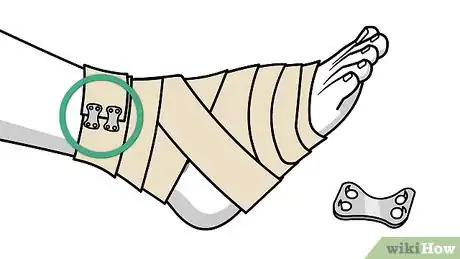Imagen titulada Wrap a Sprained Ankle Step 14