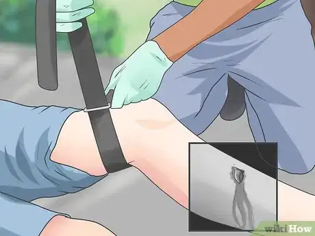 Imagen titulada Tell if a Fall Broke Bones Without an X Ray Step 10