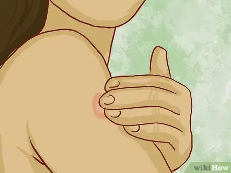Imagen titulada Read a Tuberculosis Skin Test Step 4