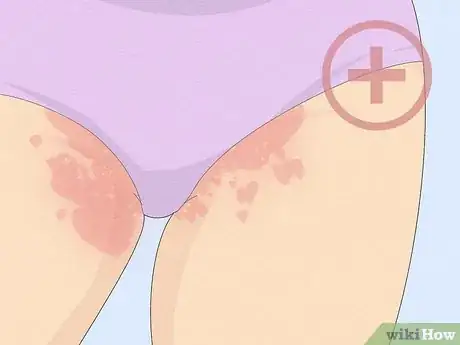 Imagen titulada Heal Raw Skin Step 10
