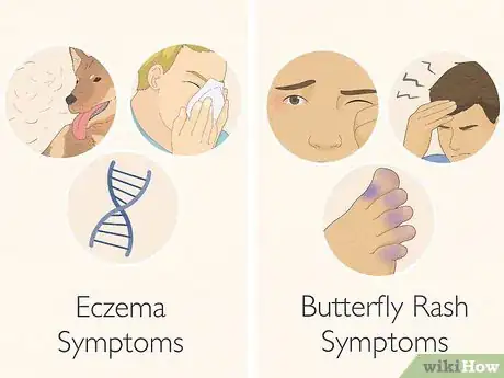 Imagen titulada Tell Eczema from Butterfly Rash Step 3
