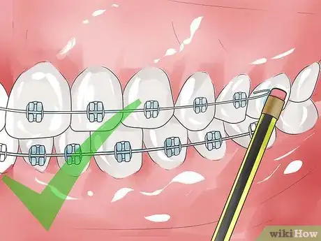 Imagen titulada Handle Poking Wires on Braces Step 6