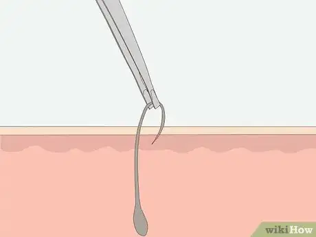 Imagen titulada Get Rid of Ingrown Pubic Hair Step 9